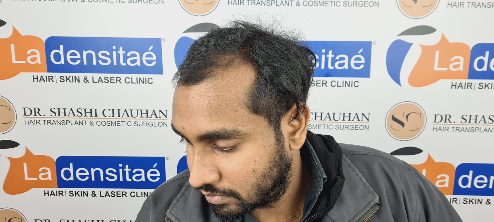 Shreyankar Maurya Before Hair Transplant